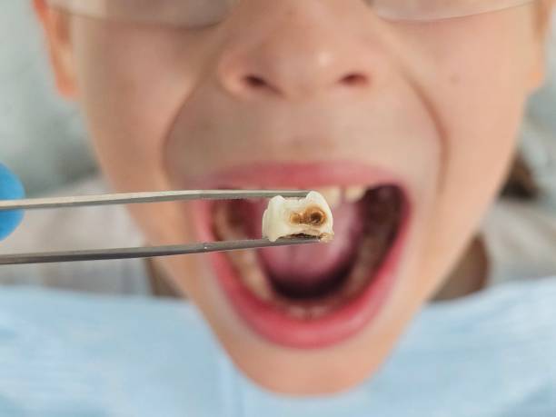 Best Emergency Dental Extractions in Plymouth, OH