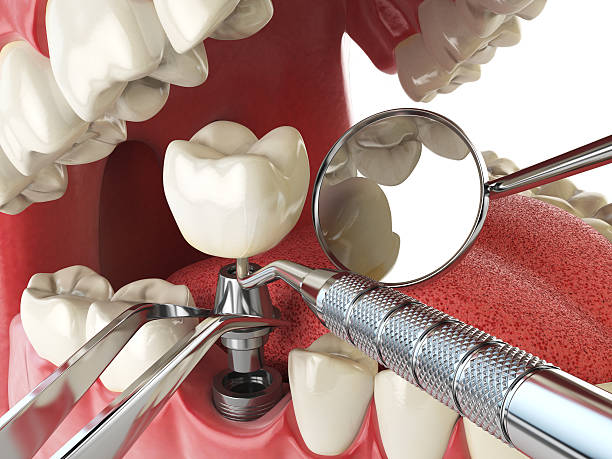 Best Emergency Dentist for Lost Fillings or Crowns in Plymouth, OH